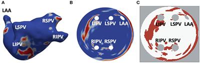 Toward Patient-Specific Prediction of Ablation Strategies for Atrial Fibrillation Using Deep Learning